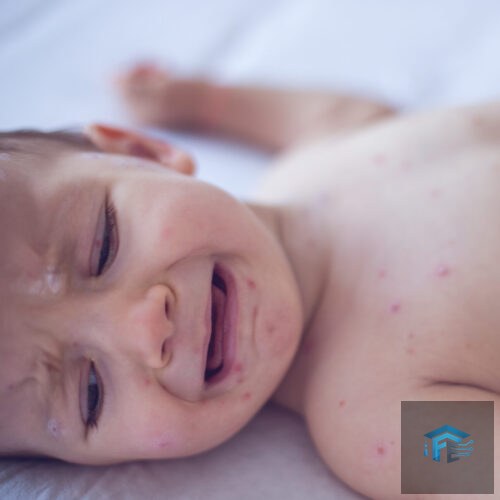 Measles killed 6-week-old baby, coroner confirms after RFK Jr. disputed deaths